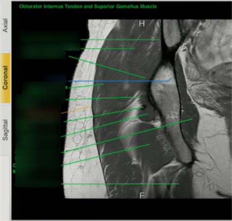 Coronal Hip MRI 8 Diagram | Quizlet