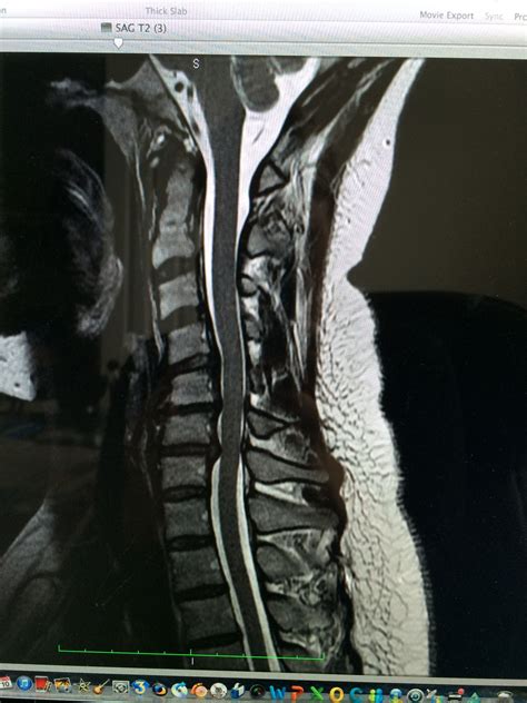 Herniated disc c5-6, c6-7 | Cervical disc, Herniated disc, Herniated