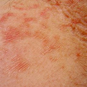 rheumatoid arthritis rashes - pictures, photos