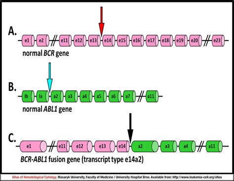 Chronic myeloid leukaemia (CML), ''BCR-ABL1''-positive: chronic phase - CELL - Atlas of ...