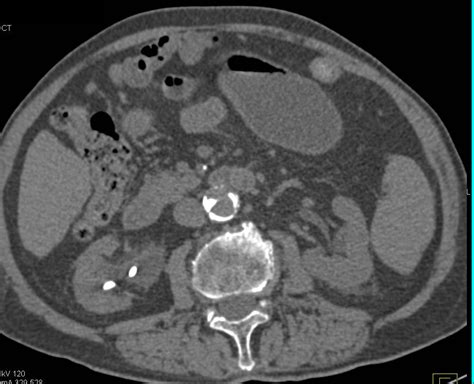 Right UPJ with Stent in Place - Kidney Case Studies - CTisus CT Scanning