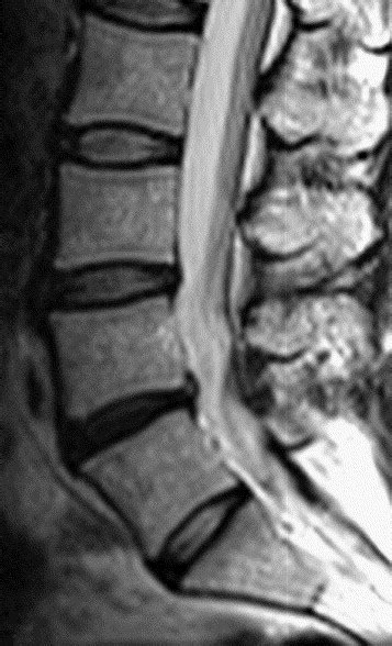 Imaging of lumbosacral transitional vertebrae - Clinical Radiology