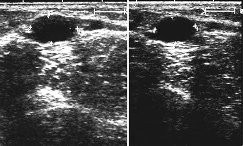 Ultrasound in Varicose Vein Treatment | Radiology Key