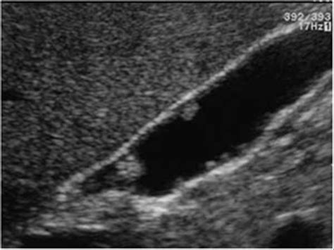 Abdomen and retroperitoneum | 1.2 Gallbladder and bile ducts : Case 1.2 ...