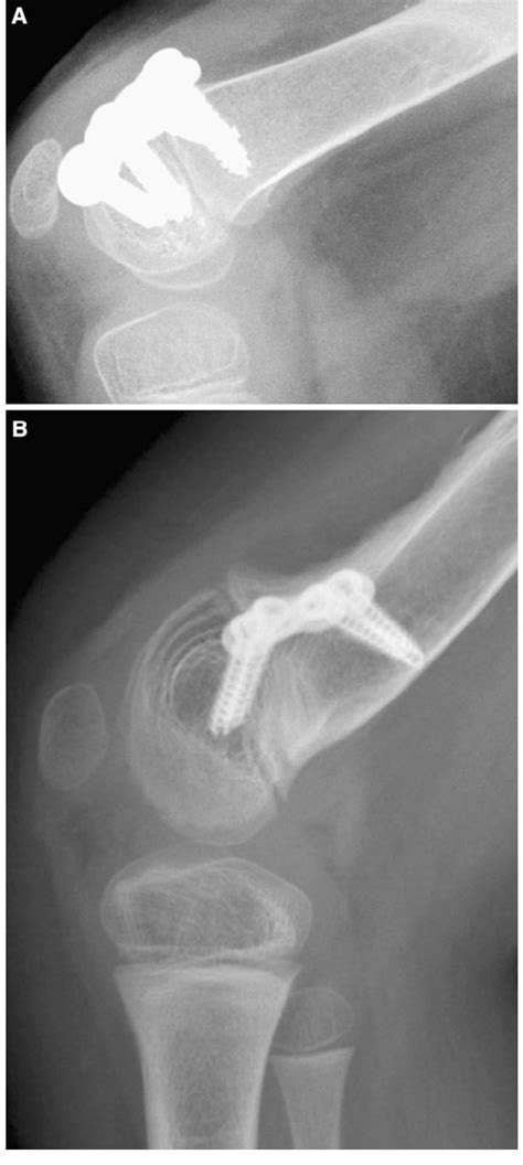 a A patient with CP and fixed knee flexion contracture treated with ...