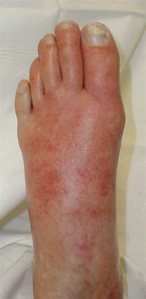 Medical Pictures Info – Cellulitis Foot