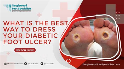 What is the Best Way to Dress Your Diabetic Foot Ulcer? - Diabetes