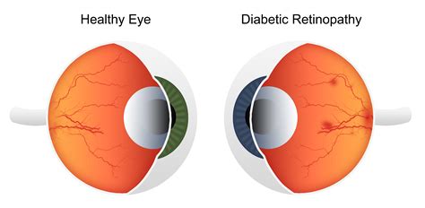 Diabetes | Associates Eye Care