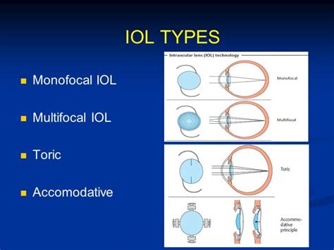 How to choose cataract lenses or IOL (intraocular lenses)