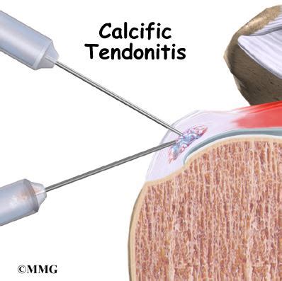 Calcium Deposits & Tendinitis (Calcific Tendinitis) | Singapore Sports & Orthopaedic Surgeon