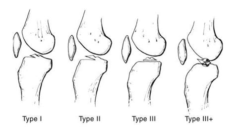 Tibial Eminence—Spine Fracture - Steven Chudik MD