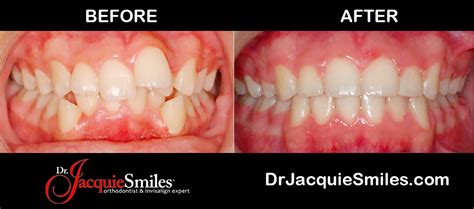 Invisalign Clear Braces Treatment for Crossbite Teeth in NYCDr. Jacquie