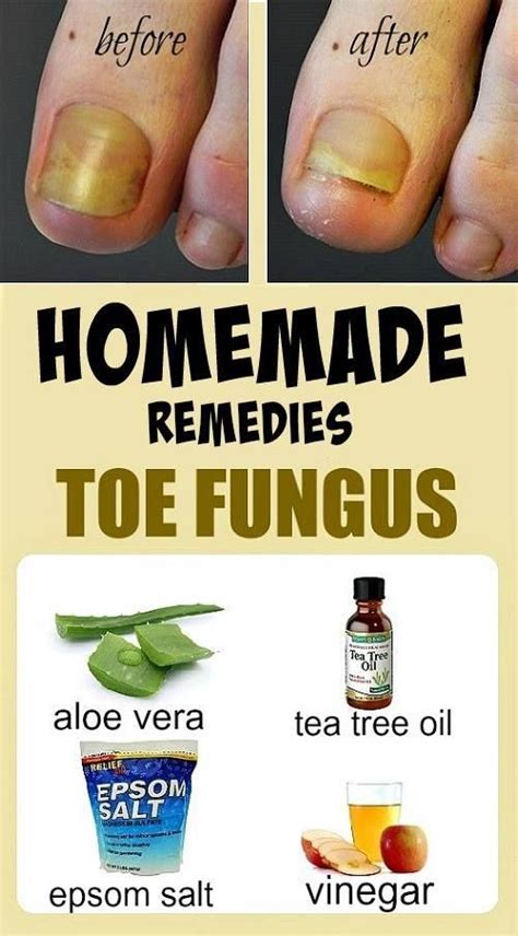 47 Cool Strong Home Remedies For Toe Fungus - Home Decor Ideas