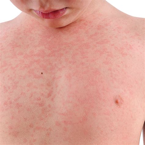 Rashes In Children