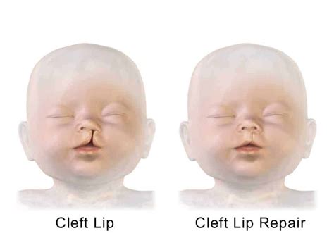 Cleft Lip