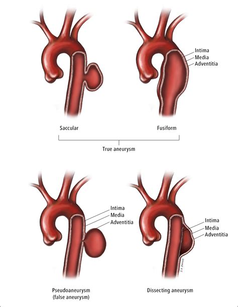 Life Expectancy After Thoracic Aortic Aneurysm Surgery - Good Life Chiropractic