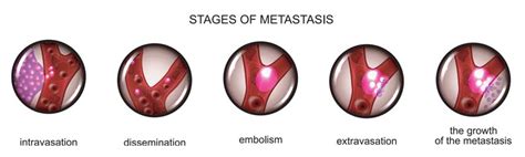 Stages-of-Metastasis – Actorius