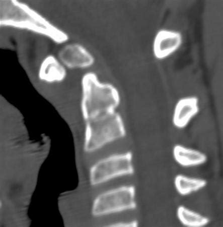 Atlantoaxial Instability - Spine - Orthobullets