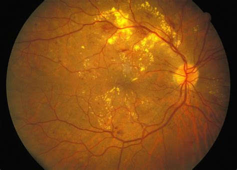 The Many Potential Ocular Manifestations in Patients With SCD