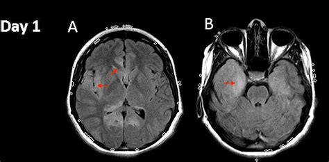 Cureus | Fulminant Herpes Simplex Virus Type I Encephalitis Despite Maximal Medical Therapy