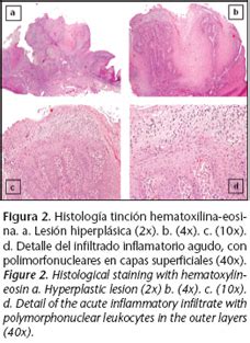 Oral Candidiasis Histology