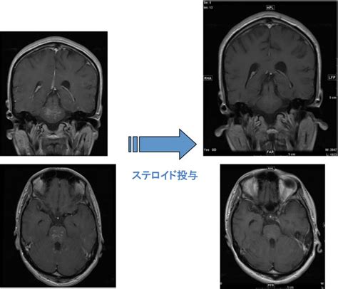 Clippers Syndrome / Comparison of 7.0T and 3.0T MRI (patients 5 and 6 ...