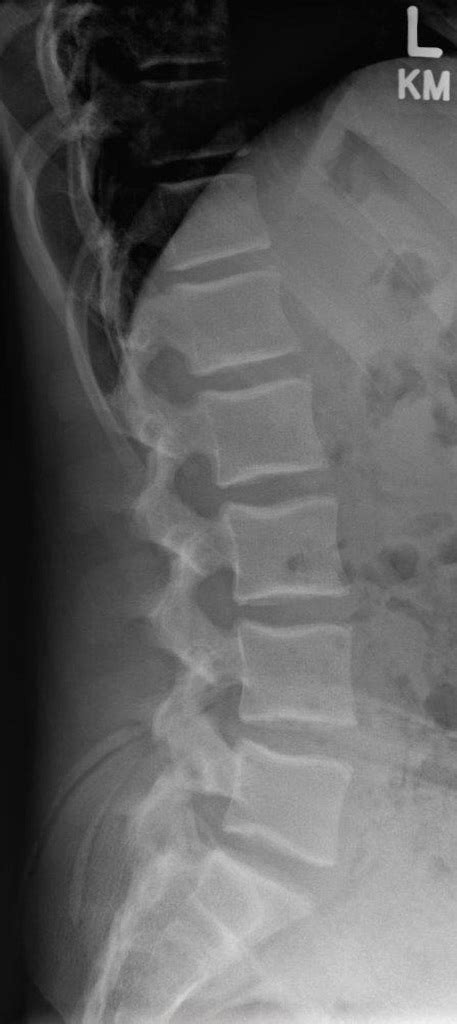 Lumbar Spine Xray Anatomy