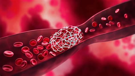 Tenecteplase outperforms standard stroke treatment - Medical Update Online