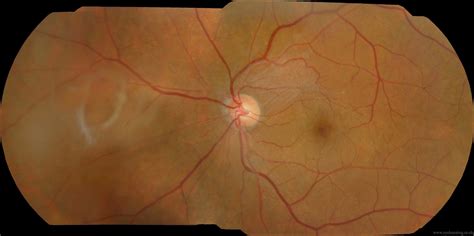 Posterior Vitreous Detachment (PVD) - Dr Rehman Siddiqui