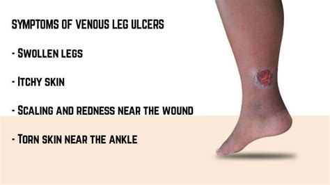 Venous Leg Ulcer: Symptoms, Causes, and Prevention