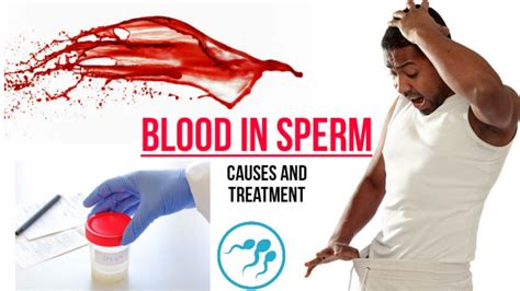 Blood in Sperm [ HEMATOSPERMIA ] Causes And Treatment. - YouTube