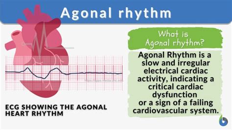 Agonal rhythm - Definition and Examples - Biology Online Dictionary