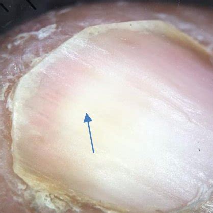 Total dystrophic onychomycosis: Ruinous aspect of subungual... | Download Scientific Diagram