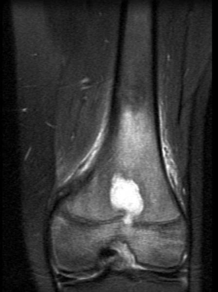 Brodie abscess MRI - wikidoc