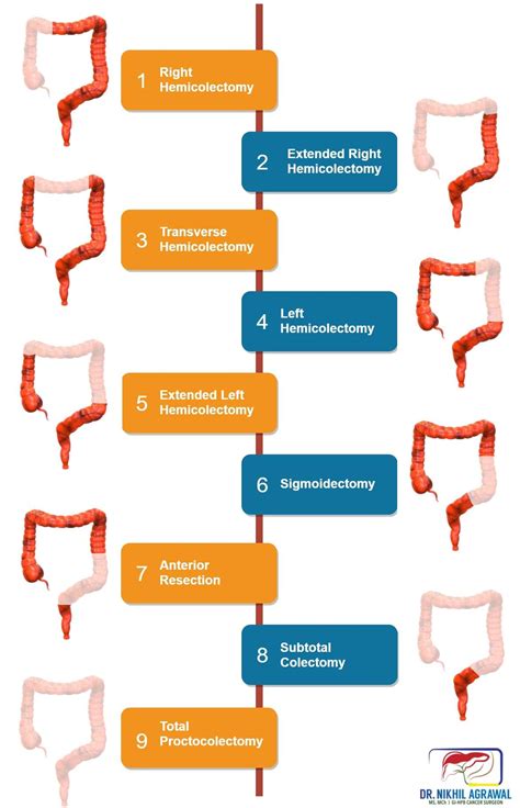 Colon cancer treatment: surgery | Colectomy | Dr. Nikhil Agrawal