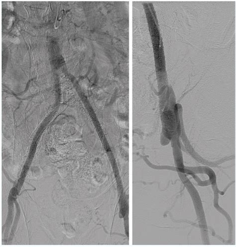 Left Superficial Femoral Artery Occlusion in a Patient With an Aortobifemoral Graft ...