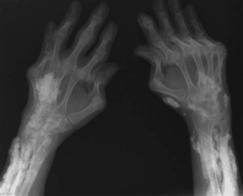 Calcinosis universalis | Journal of Hospital Medicine