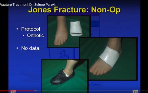 Treatment of Jones Fractures — OrthopaedicPrinciples.com