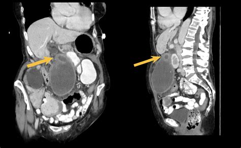 Percutaneous Cholecystostomy Tube Leading to a “Floating” Gallbladder: A Case Report | Cureus