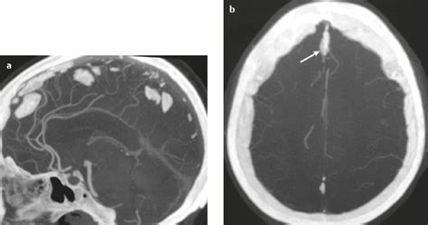 3 Extra-Axial Lesions | Radiology Key