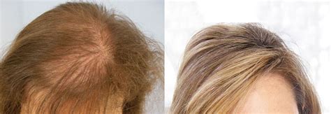 What Is An Artificial Hair Transplant? | Wimpole Clinic