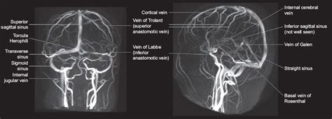 Superior Sagittal Sinus Thrombosis