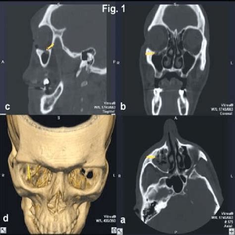 3D CT Orbit | Test Price in Delhi | Ganesh Diagnostics