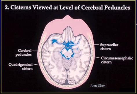 Blood Can Be Very Bad! - How to Read an Emergent Head CT — Downeast ...