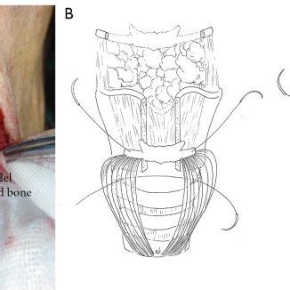 Surgical defect of the larynx after extensive partial laryngectomy.... | Download Scientific Diagram