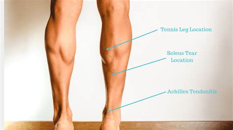 Calf Muscle Pain | Causes of Calf Muscle Pain | Sore Calf Muscle