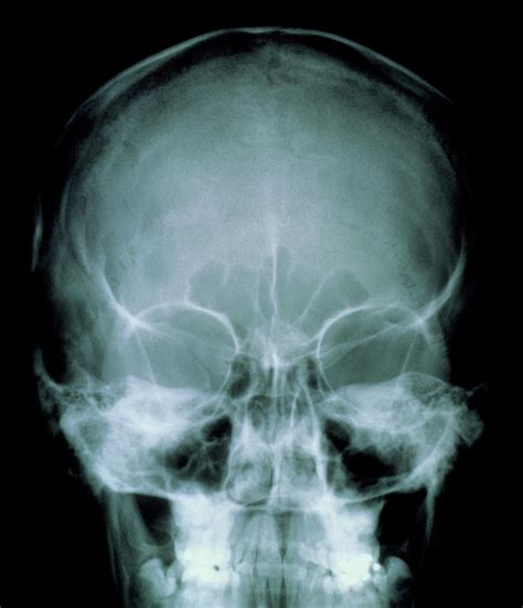 X-ray Of The Skull Front View Photograph by Science Photo Library - Fine Art America