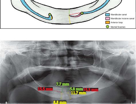 Mandibular incisive canal in edentulous patients: Analysis by means of ...