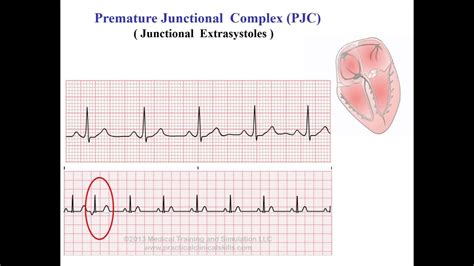 Premature Junctional Contraction (PJC) Premature Atrial, 55% OFF