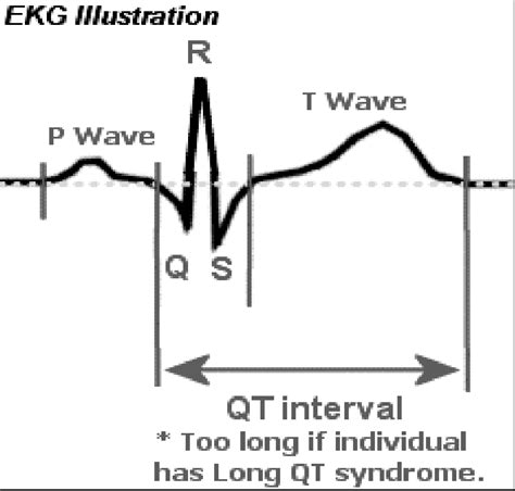 ECG illustration of measurement of a QT interval Bazett formula: QTc =... | Download Scientific ...